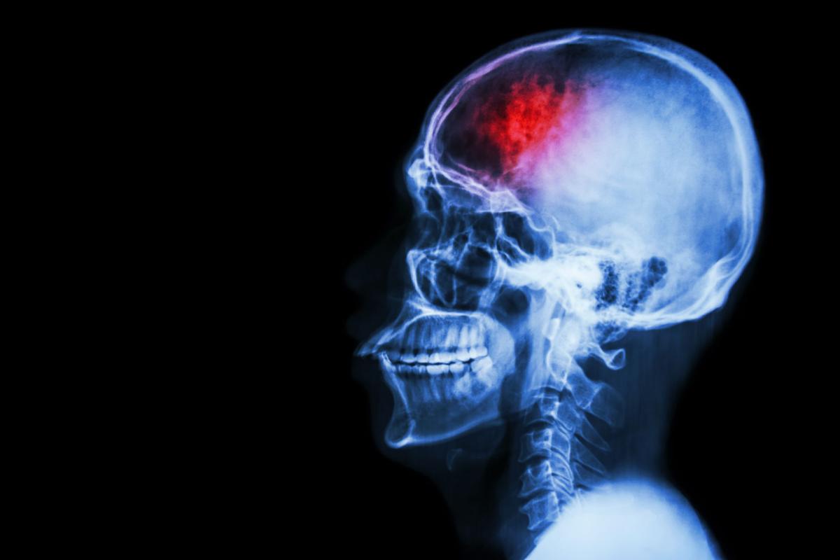 Stroke and Aneurysm Virtual Meeting