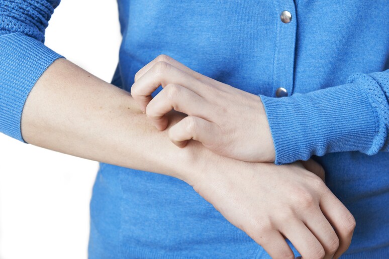 Cosa è la psoriasi e quali sintomi porta?
